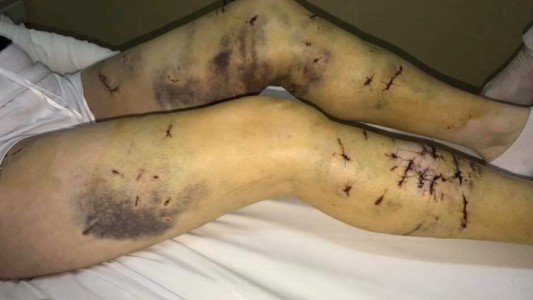 Alerta en Ushuahia: una jauría de perros salvajes atacó brutalmente a una mujer