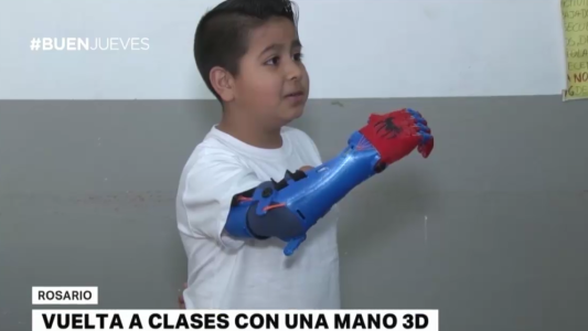 Un  nene de Rosario recibió una mano impresa en 3D