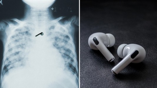 Se quedó dormido y se tragó uno de sus AirPods: los auriculares aún funcionan