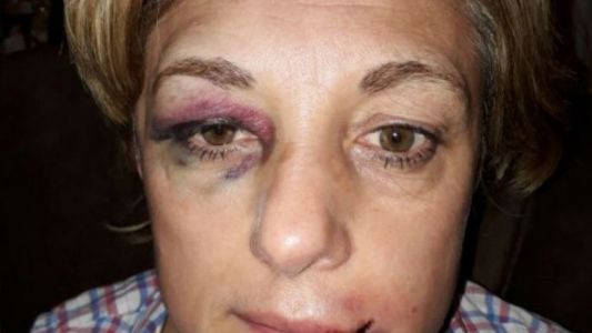 La golpearon y le robaron el dinero que había ahorrado para una peluca oncológica