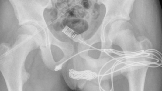 Un chico intentaba medir su pene y se le enredó un cable USB en la uretra: tuvieron que operarlo