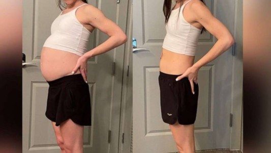 Hizo dieta y ejercicios durante 8 meses, pero no adelgazaba: le descubrieron un enorme tumor en el estómago