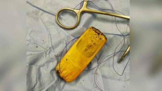 Se quejaba de un fuerte dolor y descubrieron que tenía un celular en los intestinos