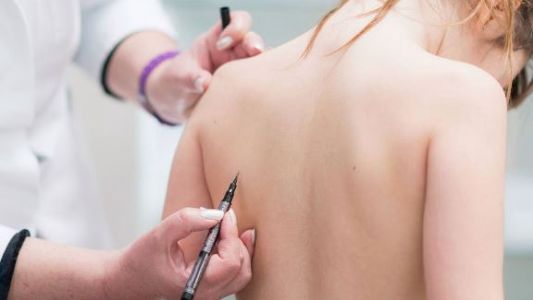 Escoliosis: buscan incluir su detección en los controles de salud de los colegios