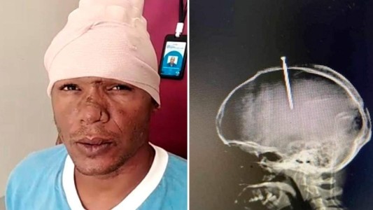Alucinaba por las drogas y se le incrustó un clavo en la cabeza: los cirujanos le salvaron la vida