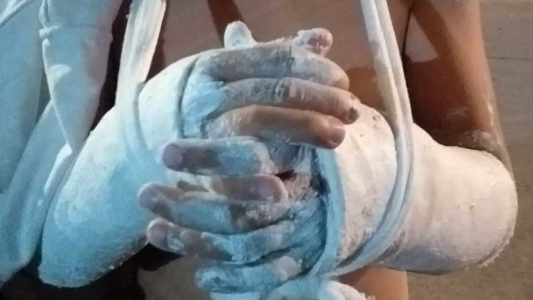Se quebró las dos muñecas jugando en una plaza por las negligencias de la hamaca