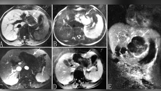"Jamás vi algo así": pediatra atendió a una mujer embarazada con el feto en el hígado