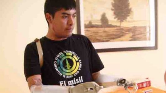 Implantan brazos "mecánicos" a un joven jujeño