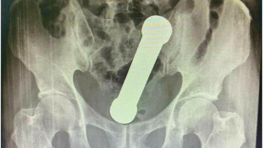 Un hombre va al hospital por dolor de estómago: le extrajeron mancuerna de dos kilos del cuerpo