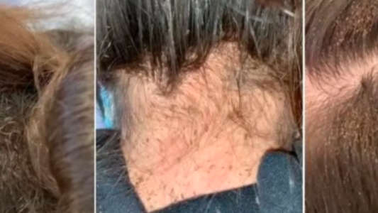 Video: la nena que llevaba seis meses con piojos hasta en el cuello