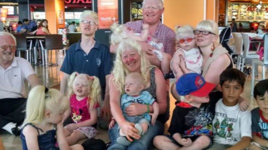 Presentan un proyecto de ley de asistencia integral a personas con albinismo en CABA