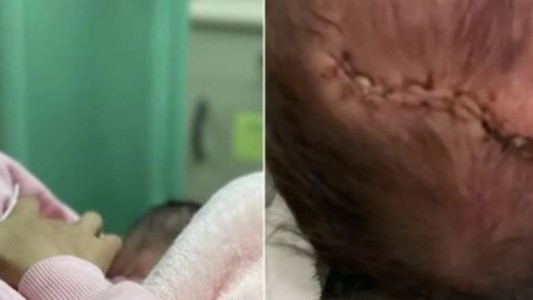 Una bebé recién nacida cayó de cabeza minutos después del parto y tuvieron que darle 11 puntos de sutura
