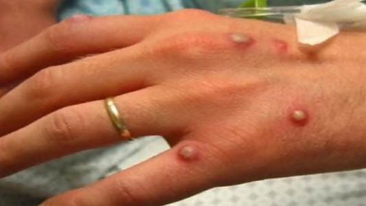 Piden que contactos estrechos de contagiados con viruela del mono se aíslen 21 días