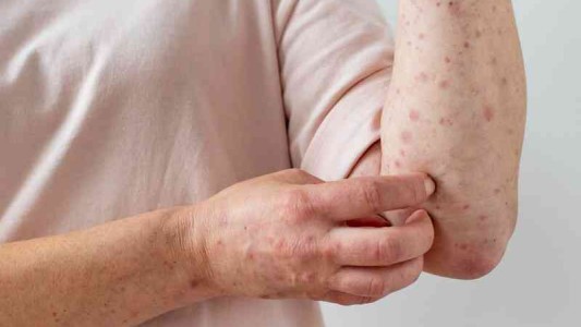 La Comisión Europea acordó comprar 100.000 dosis de vacunas contra la viruela del mono