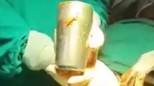 Fue al médico por dolores abdominales, lo operaron y le sacaron una copa de acero del estómago
