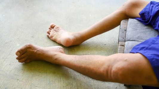 Reino Unido reactiva una campaña de vacunación contra la polio en niños de entre 1 y 9 años