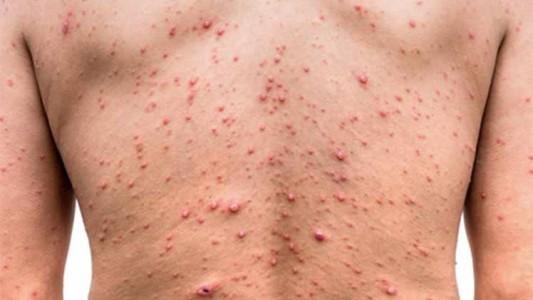 Europa roza ya los 20.000 casos de viruela del mono