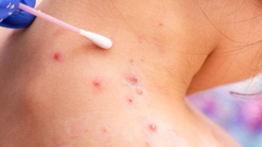 Viruela del mono: confirman un total de 396 casos en la Argentina