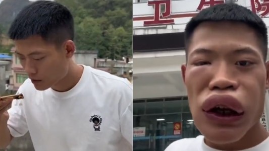 Desfigurado: así terminó un influencer tras comerse una avispa viva