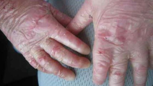 Bebés que nacen con ampollas pueden tener “Piel de Cristal”