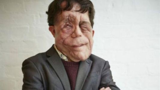 El drama de vivir con una desfiguración facial: "Me han llamado mutante deforme"