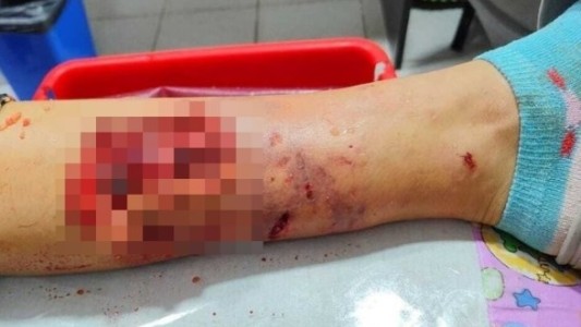 "La arrastró dándole varias vueltas": un pitbull suelto atacó a una nena en la calle y tuvieron que operarla de urgencia