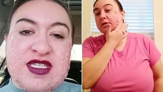 "Me dicen Freddy Krueger": sufre una rara enfermedad de la piel y el bullying