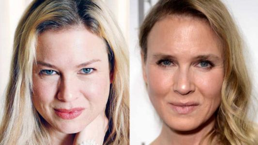 Los rostros de las estrellas antes y después de las cirugías