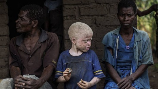 Brujería en Africa, el cruento destino de los albinos negros