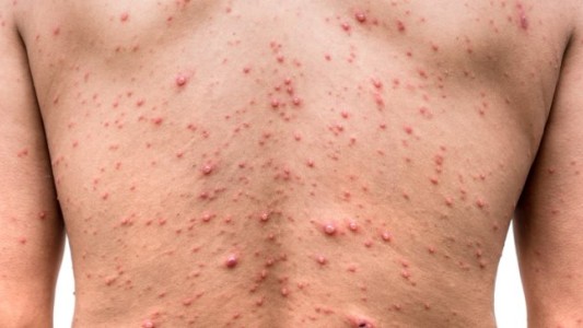 La OMS aseguró que la viruela del mono ya no es una emergencia sanitaria global