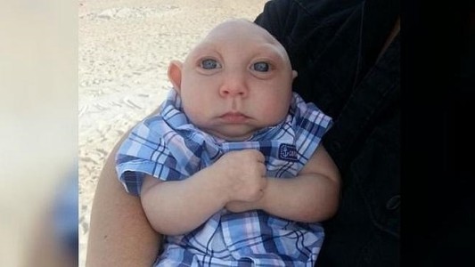 El bebé que nació con media cabeza sobrevivió y ya cumplió un año