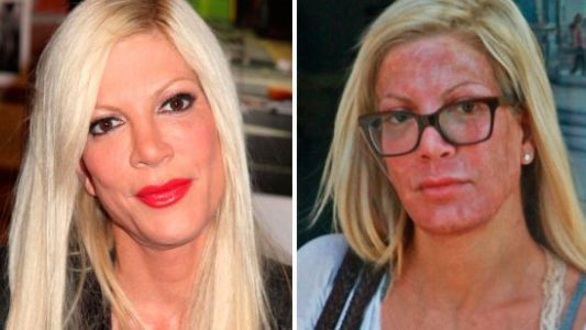 La protagonista de Beverly Hills 90210 que se desfiguró la cara