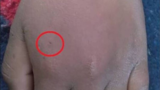 Para convertirse en Spiderman, un nene se hizo morder por una araña viuda negra: quedó internado