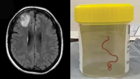 Extraen una lombriz de 8 centímetros del cerebro de una mujer