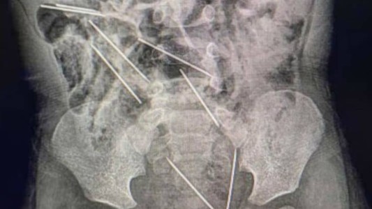 Llevó a su hijo de 2 años con fuertes dolores al hospital y tuvieron que operarlo de urgencia por lo que se había tragado