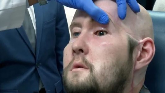 Médicos de Nueva York realizaron con éxito el primer trasplante de ojo del mundo
