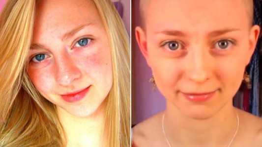 Video: la joven que no puede parar de arrancarse los pelos de la cabeza