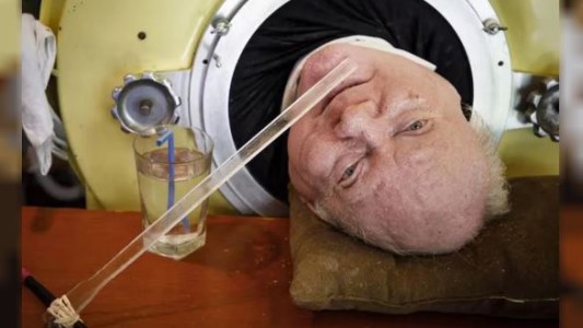 Murió Paul Alexander, el hombre que vivió durante más de 70 años conectado a un pulmón de hierro