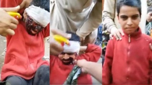 Nene se hacía pasar como quemado para pedir limosna