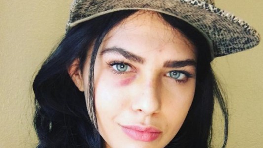 Video: la joven que fue golpeada por un drone en una producción de moda