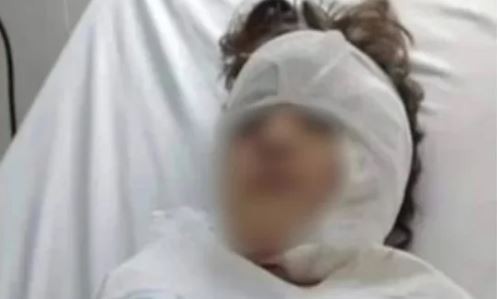 Un pitbull atacó a una niña en Río Gallegos, le desfiguró la cara y deberá someterse a varias cirugías