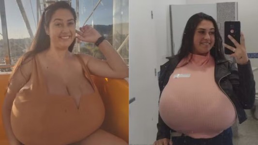 La pesadilla de vivir con gigantomastia: "Mis senos crecieron 10 kilos en unos meses, no aguanto más"