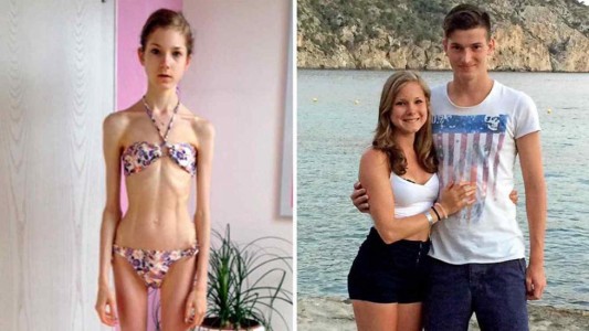 Sufría anorexia, llegó a pesar 22 kilos y el amor de su novio la salvó