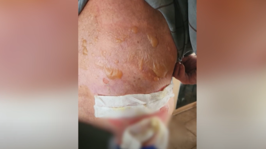 Torturaron a un jubilado para robarle: los delincuentes calentaron agua y lo quemaron