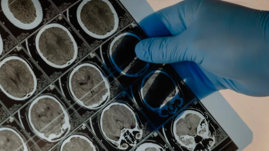 Un adolescente vive hace 5 años con un balín incrustado en la cabeza