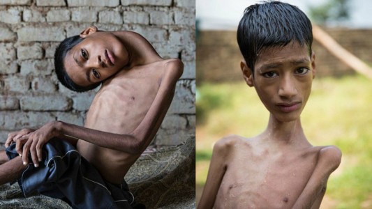 Fue operado con éxito el chico que tenía el cuello colgando