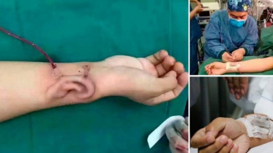 Fotos: perdió la oreja en un accidente y se la cultivaron en el brazo