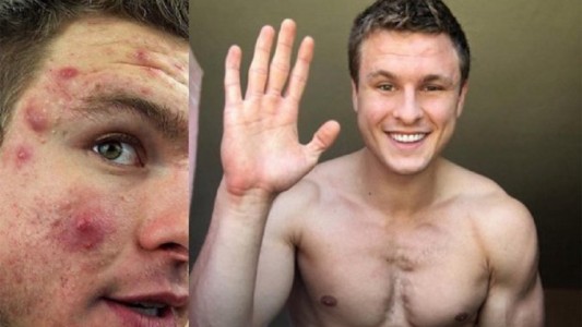 La historia del joven que venció al acné