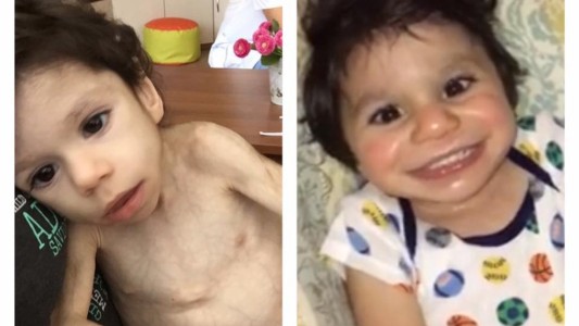 La increible recuperación de un nene de 7 años que pesaba 3 kilos y fue adoptado