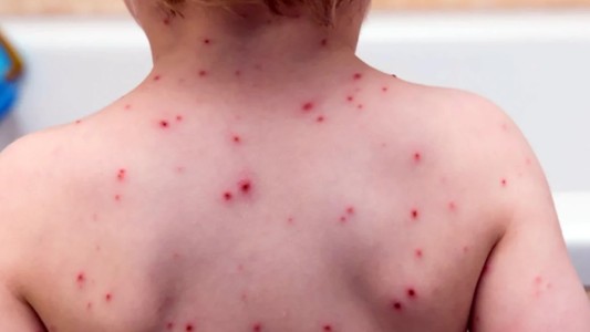 El brote de sarampión en Estados Unidos supera los 1.000 casos confirmados